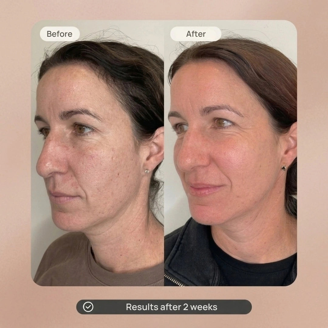 Microcurrent Facial Treatment